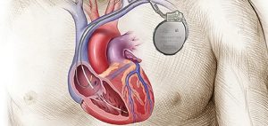 Implantable Cardioverter Defibrillator (ICD)